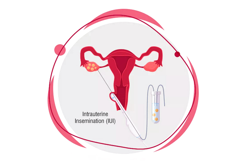 IUI