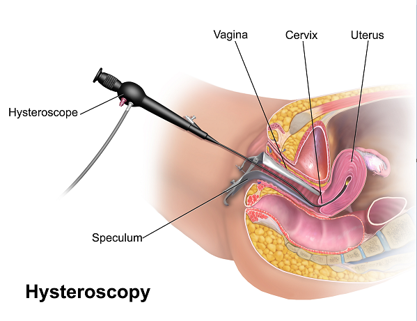 Hysteroscopy and Laparoscopy